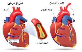 عدم توانایی قلب در پمپاژ خون (نارسایی احتقانی قلب )
