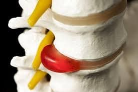 دیسک کمر (جزوه )